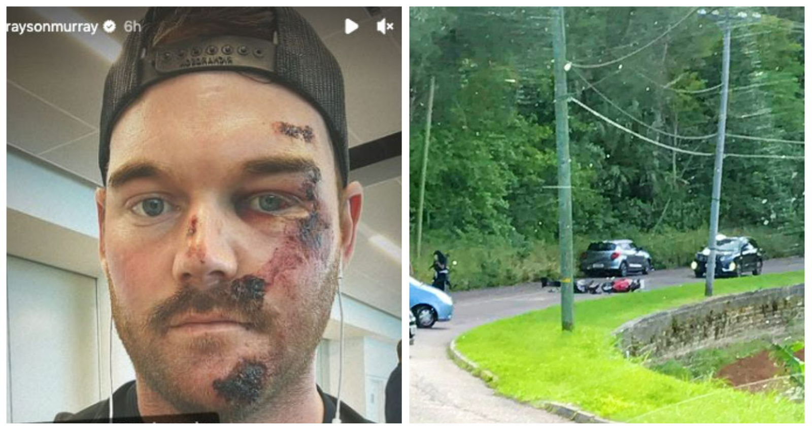 PGA Tour pro shares image of nasty cuts after scooter crash